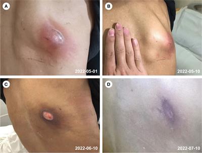 A complicated infection by cutaneous Nocardia wallacei and pulmonary Mycobacterium abscessus in a Chinese immunocompetent patient: a case report